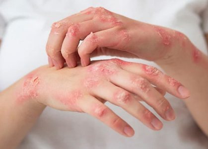 Viêm da cơ địa có thể gặp ở cả người lớn và trẻ nhỏ